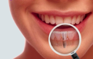 Implantes Dentales